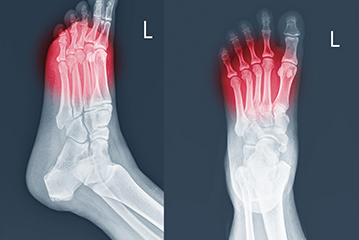 Foot and ankle fractures