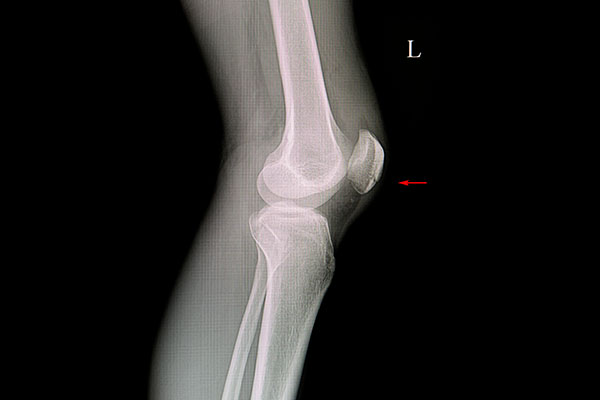 Xray of a Dislocated Joint in Knee