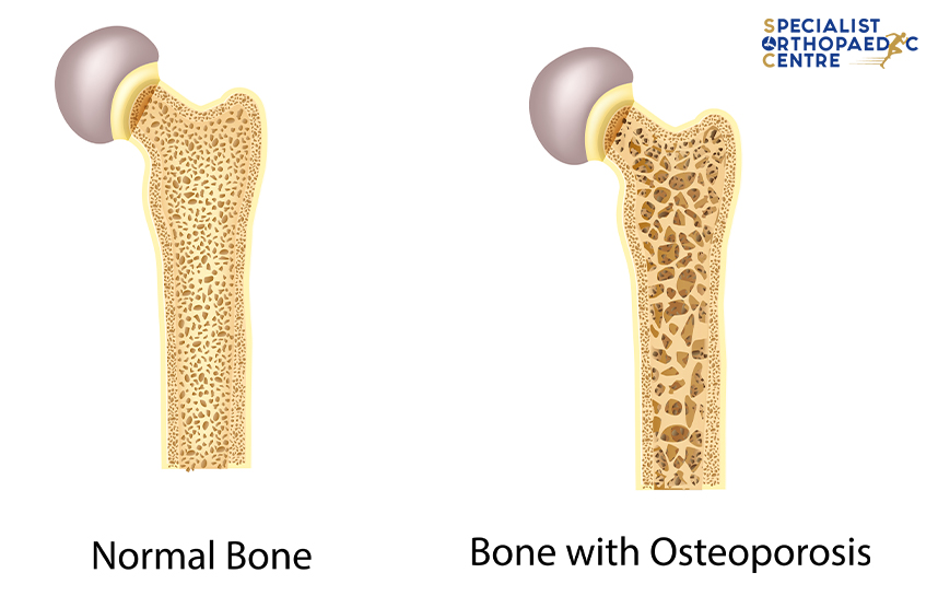 Osteoporosis Orthopaedic Clinic in Singapore