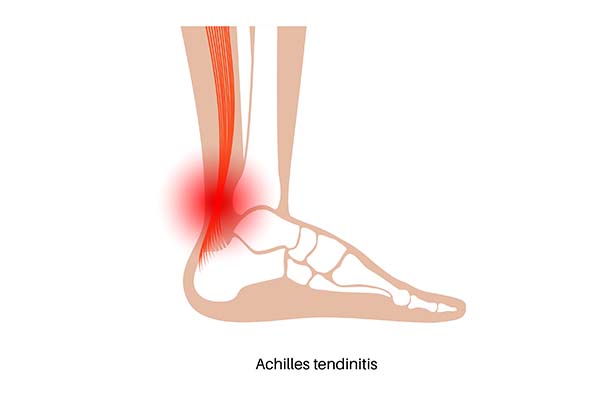 What You Need to Know About Achilles Tendonitis Treatment