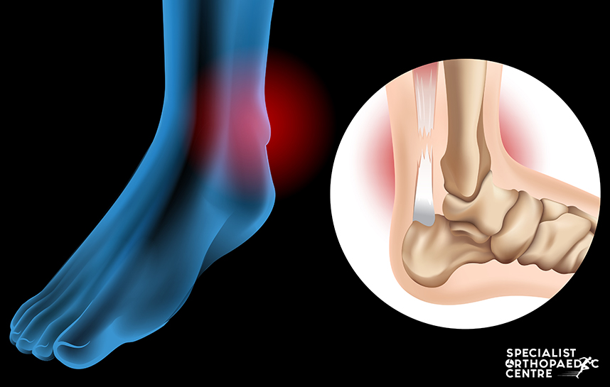 Achilles Tendon Injuries: Risk Factors & Treatments