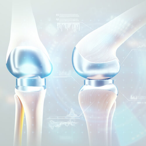 Partial vs Total Knee Replacements