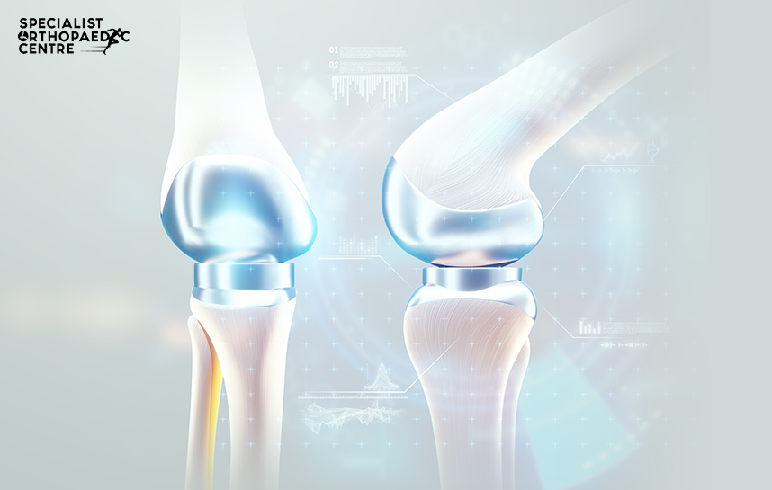 Partial vs Total Knee Replacements