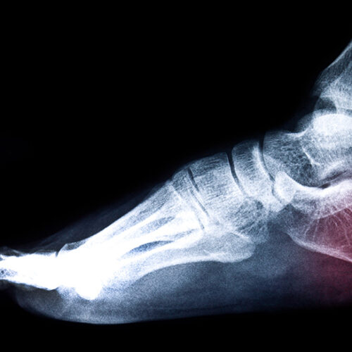 Understanding Bone Spurs And How To Treat Them