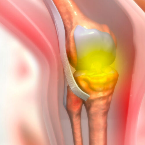 Determining Candidates For Partial Knee Replacement Surgeries