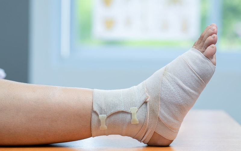 Injured foot wrapped in a medical support bandage for recovery.